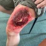DAC-Education-FROS-First-Aid-Course-mock-Leg-Injury-1920w